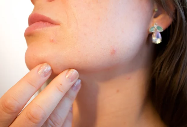 ಗುಳ್ಳೆಗಳನ್ನು ತಡೆಯಲು  ಮನೆಮದ್ದುಗಳು|Get rid of pimples with home remedies